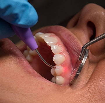 Implant Procedure by Dentist